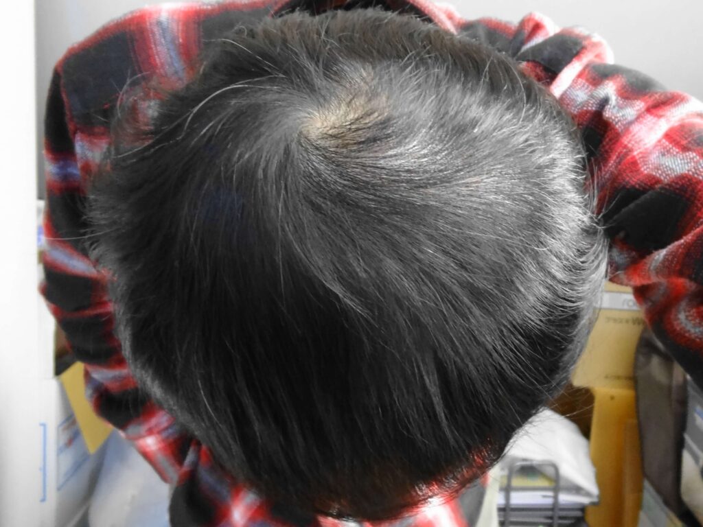 クリニックフォアAGA治療の症例画像