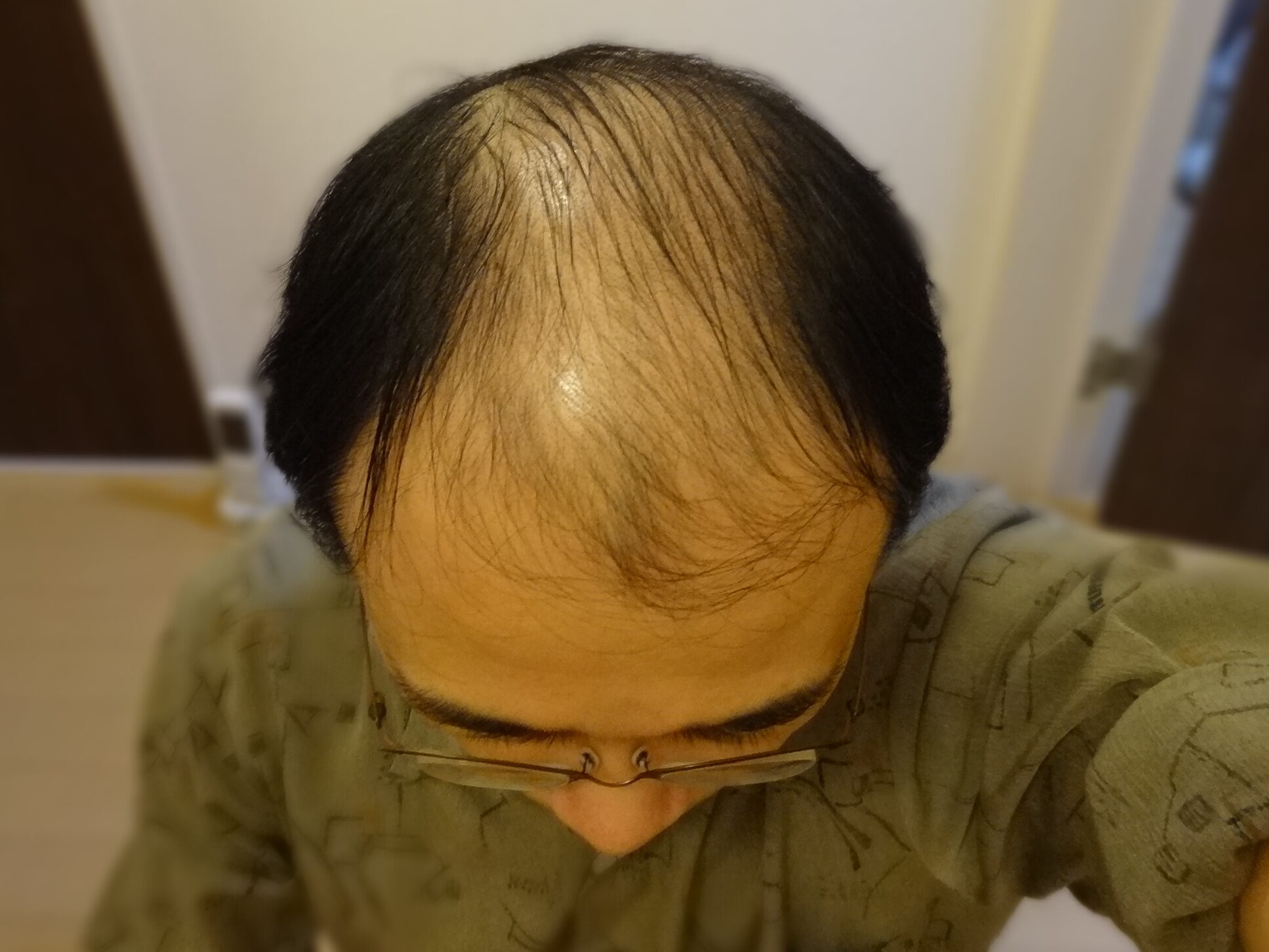 クリニックフォアAGA治療の症例画像