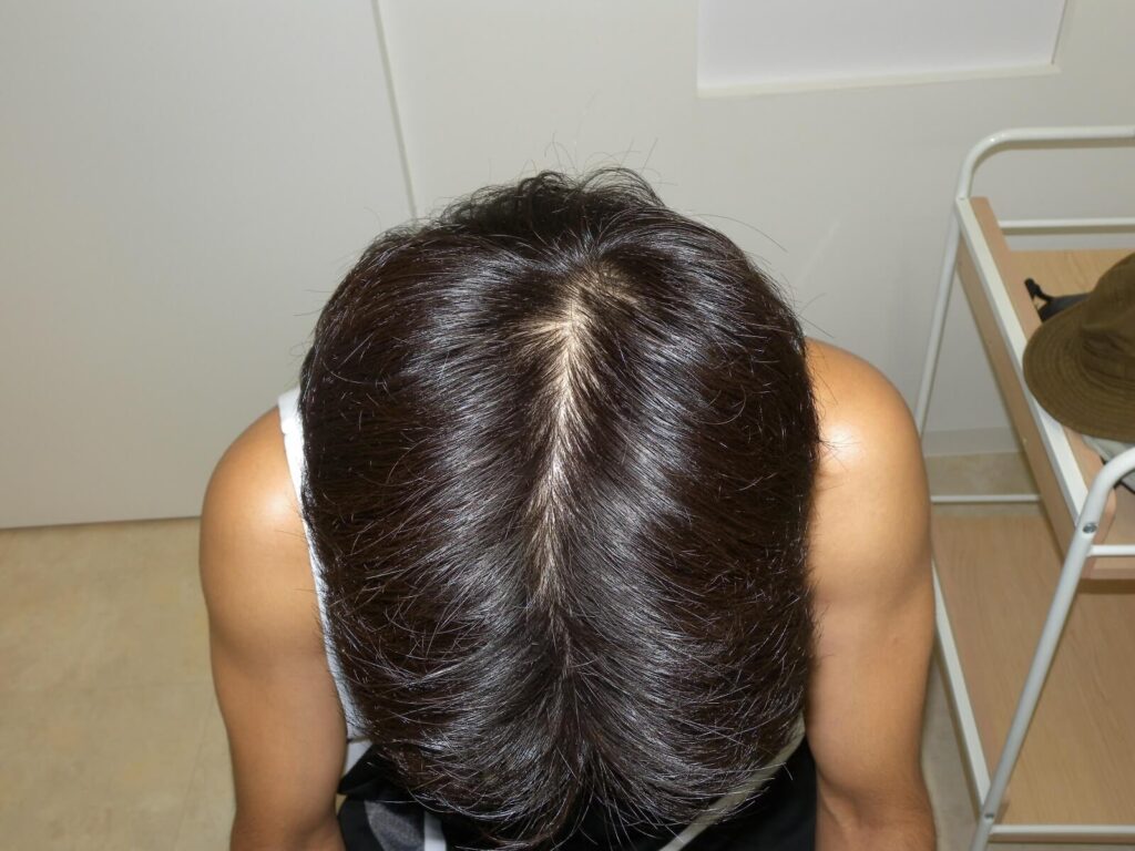 Oops HAIRの症例画像