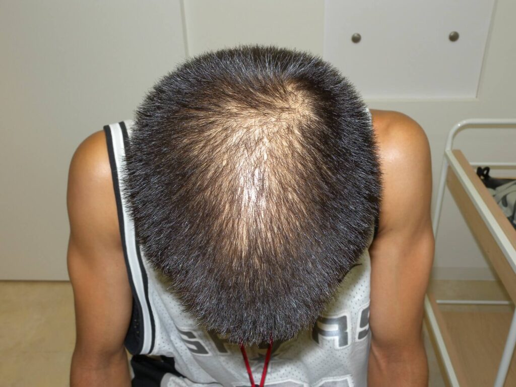 Oops HAIRの症例画像